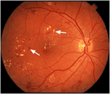 Picture of Diabetic Retinopathy