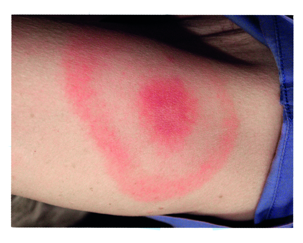 'Bullseye' rash image 